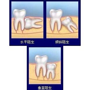 有些患者智齿结构为复杂,在拔智齿前需进行拍x光片以了解智齿的